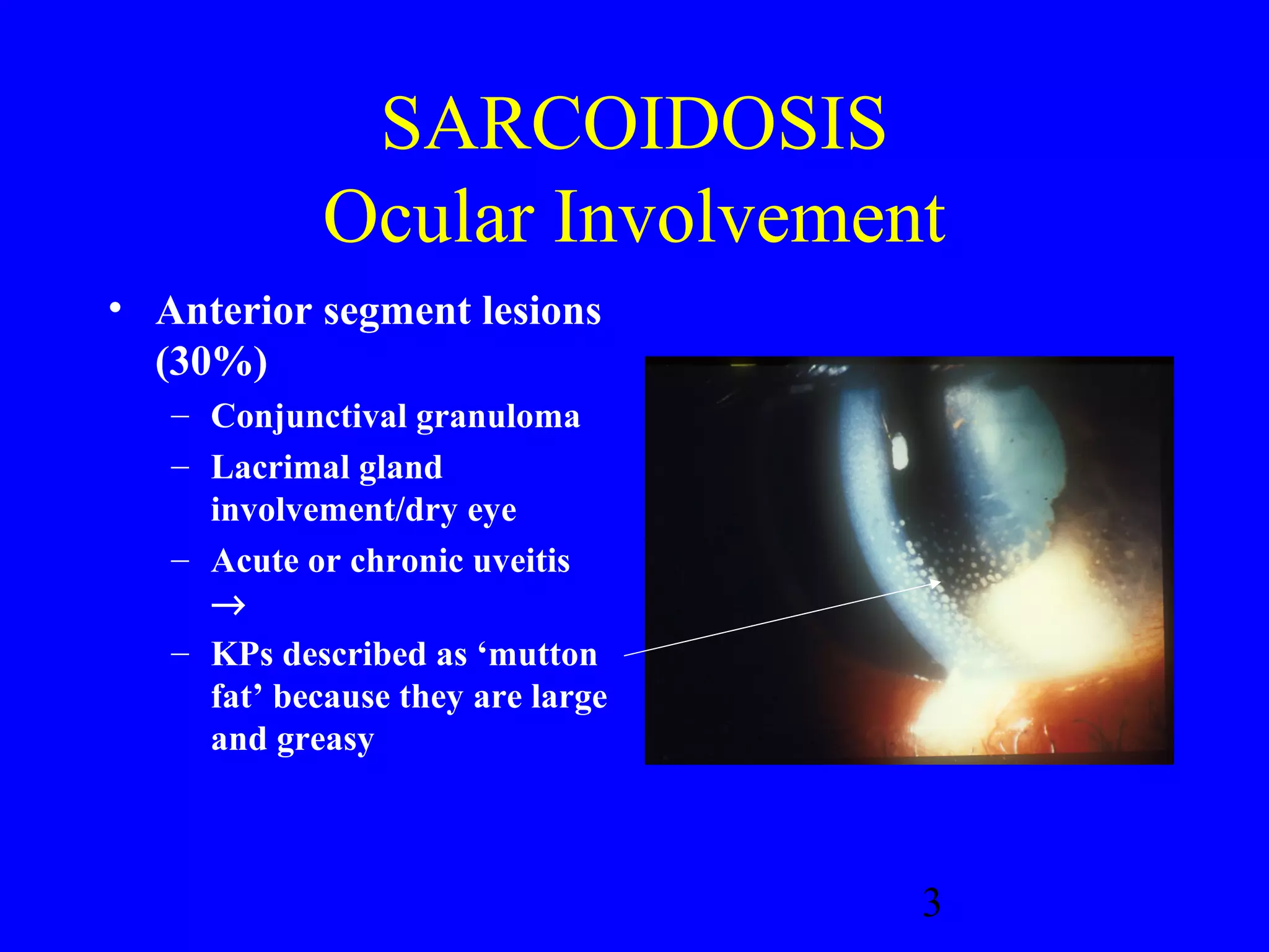 Sarcoidosis PPT sarcoidosis-ppt