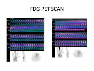 FDG PET SCAN
 