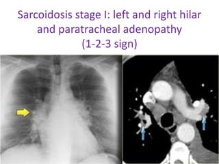 Sarcoidosis stage I: left and right hilar
and paratracheal adenopathy
(1-2-3 sign)
 