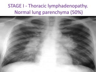 STAGE I - Thoracic lymphadenopathy.
Normal lung parenchyma (50%)
 