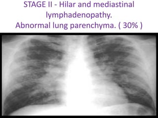 STAGE II - Hilar and mediastinal
lymphadenopathy.
Abnormal lung parenchyma. ( 30% )
 