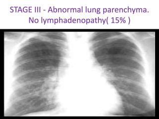 STAGE III - Abnormal lung parenchyma.
No lymphadenopathy( 15% )
 