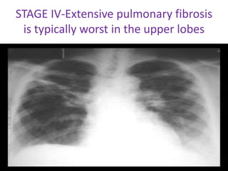 STAGE IV-Extensive pulmonary fibrosis
is typically worst in the upper lobes
 