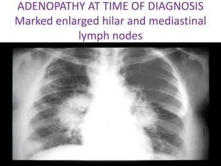 ADENOPATHY AT TIME OF DIAGNOSIS
Marked enlarged hilar and mediastinal
lymph nodes
 