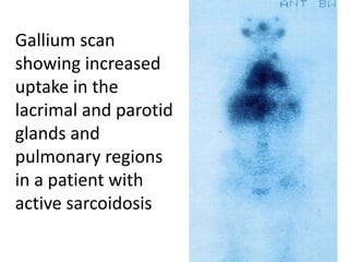 Gallium scan
showing increased
uptake in the
lacrimal and parotid
glands and
pulmonary regions
in a patient with
active sarcoidosis
 