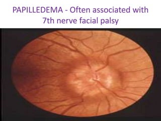 PAPILLEDEMA - Often associated with
7th nerve facial palsy
 