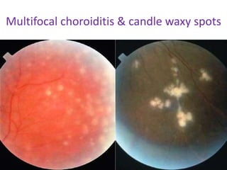 Multifocal choroiditis & candle waxy spots
 