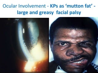 Ocular Involvement - KPs as ‘mutton fat’ -
large and greasy facial palsy
 