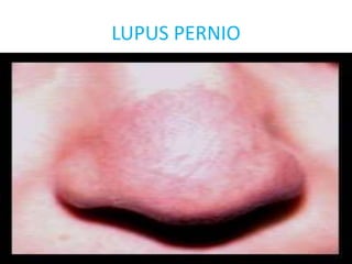 LUPUS PERNIO
 