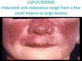 LUPUS PERNIO
Indurated and violaceous range from a few
small lesions to large lesions
 