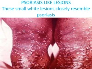 PSORIASIS LIKE LESIONS
These small white lesions closely resemble
psoriasis
 
