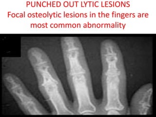PUNCHED OUT LYTIC LESIONS
Focal osteolytic lesions in the fingers are
most common abnormality
 