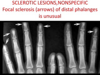 SCLEROTIC LESIONS,NONSPECIFIC
Focal sclerosis (arrows) of distal phalanges
is unusual
 