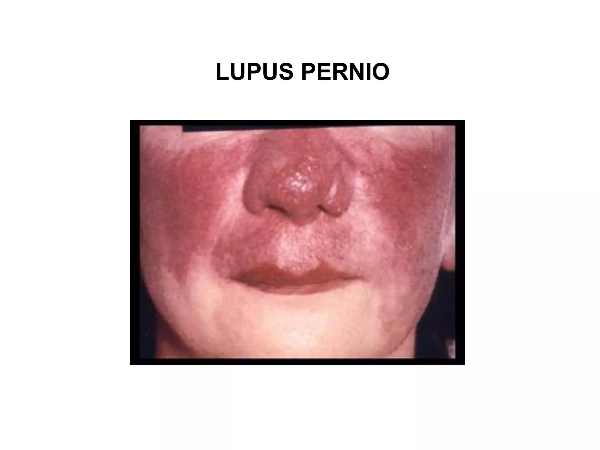 pulmonary-sarcoidosis-pdf