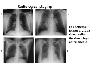 Radiological staging
CXR patterns
(stages 1, 2 & 3)
do not reflect
the chronology
of the disease
1
2
3 4
 