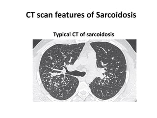 Typical CT of sarcoidosis
CT scan features of Sarcoidosis
 