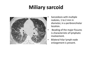 Miliary sarcoid
• Sarcoidosis with multiple
nodules, 1 to 2 mm in
diameter, in a peribronchiolar
location.
• Beading of the major fissures
is characteristic of lymphatic
involvement.
• Bilateral hilar lymph node
enlargement is present.
 