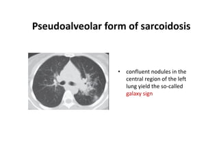 • confluent nodules in the
central region of the left
lung yield the so-called
galaxy sign
Pseudoalveolar form of sarcoidosis
 
