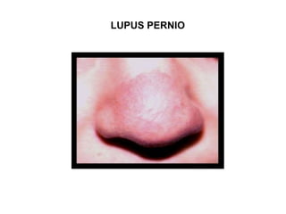 LUPUS PERNIO
 