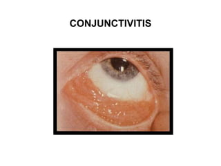 CONJUNCTIVITIS
 