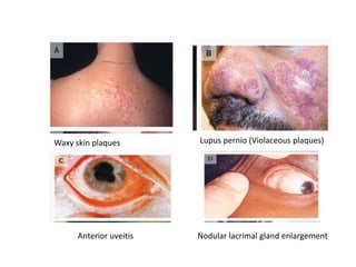 Waxy skin plaques Lupus pernio (Violaceous plaques)
Anterior uveitis Nodular lacrimal gland enlargement
 
