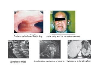 Endobronchial cobblestoning Facial palsy and VIII nerve involvement
Spinal cord mass Granulomatous involvement of humerus Hypodense lesions in spleen
 