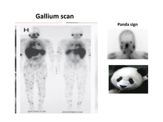 Gallium scan
Panda sign
 