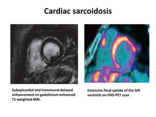 Cardiac sarcoidosis
Subepicardial and transmural delayed
enhancement on gadolinium-enhanced
T1-weighted MRI.
Extensive focal uptake of the left
ventricle on FDG-PET scan
 