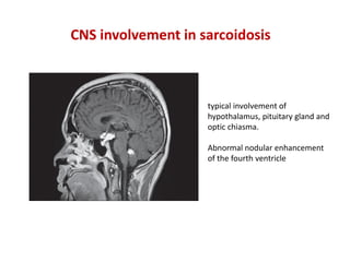 typical involvement of
hypothalamus, pituitary gland and
optic chiasma.
Abnormal nodular enhancement
of the fourth ventricle
CNS involvement in sarcoidosis
 