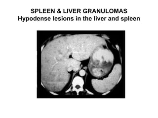 SPLEEN & LIVER GRANULOMAS
Hypodense lesions in the liver and spleen
 