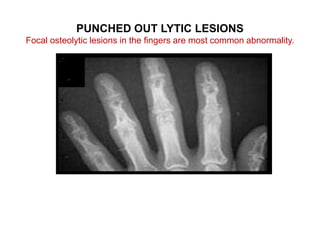 PUNCHED OUT LYTIC LESIONS
Focal osteolytic lesions in the fingers are most common abnormality.
 