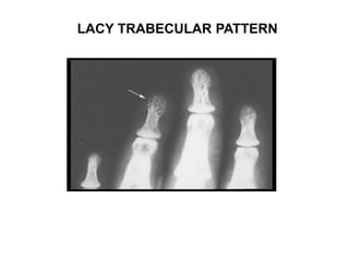 LACY TRABECULAR PATTERN
 
