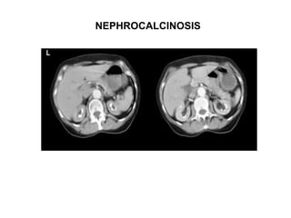 NEPHROCALCINOSIS
 