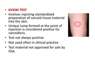• KVEIM TEST
• Involves injecting standardized
preparation of sarcoid tissue material
into the skin.
• Unique lump formed at the point of
injection is considered positive for
sarcoidosis.
• Test not always positive
• Not used often in clinical practice
• Test material not approved for sale by
FDA.
 