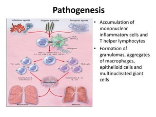 Pathogenesis
• Accumulation of
mononuclear
inflammatory cells and
T helper lymphocytes
• Formation of
granulomas, aggregates
of macrophages,
epithelioid cells and
multinucleated giant
cells
 