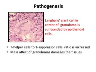 Langhans' giant cell in
center of granuloma is
surrounded by epithelioid
cells .
• T-helper cells to T-suppressor cells ratio is increased
• Mass affect of granulomas damages the tissues
Pathogenesis
 