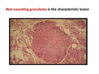 Non-caseating granuloma is the characteristic lesion
 