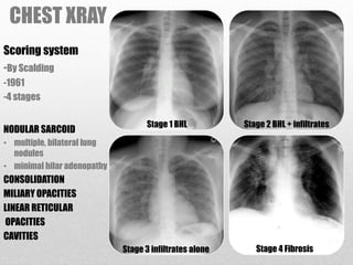 CHEST XRAY
Scoring system
-By Scalding
-1961
-4 stages
NODULAR SARCOID
• multiple, bilateral lung
nodules
• minimal hilar adenopathy
CONSOLIDATION
MILIARY OPACITIES
LINEAR RETICULAR
OPACITIES
CAVITIES
Stage 1 BHL Stage 2 BHL + infiltrates
Stage 3 infiltrates alone Stage 4 Fibrosis
 