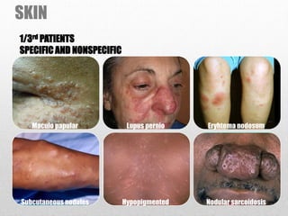 SKIN
Maculo papular Lupus pernio Eryhtema nodosum
Subcutaneous nodules Hypopigmented Nodular sarcoidosis
1/3rd PATIENTS
SPECIFIC AND NONSPECIFIC
 