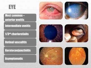 EYE
Most common –
anterior uveitis
Intermediate uveitis
1/3rd chorioretinits
Retinal vasculitis
Keratoconjunctivitis
Asymptomatic
 