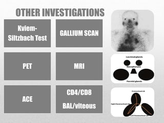 OTHER INVESTIGATIONS
Kviem-
Siltzbach Test
GALLIUM SCAN
PET MRI
ACE
CD4/CD8
BAL/viteous
 