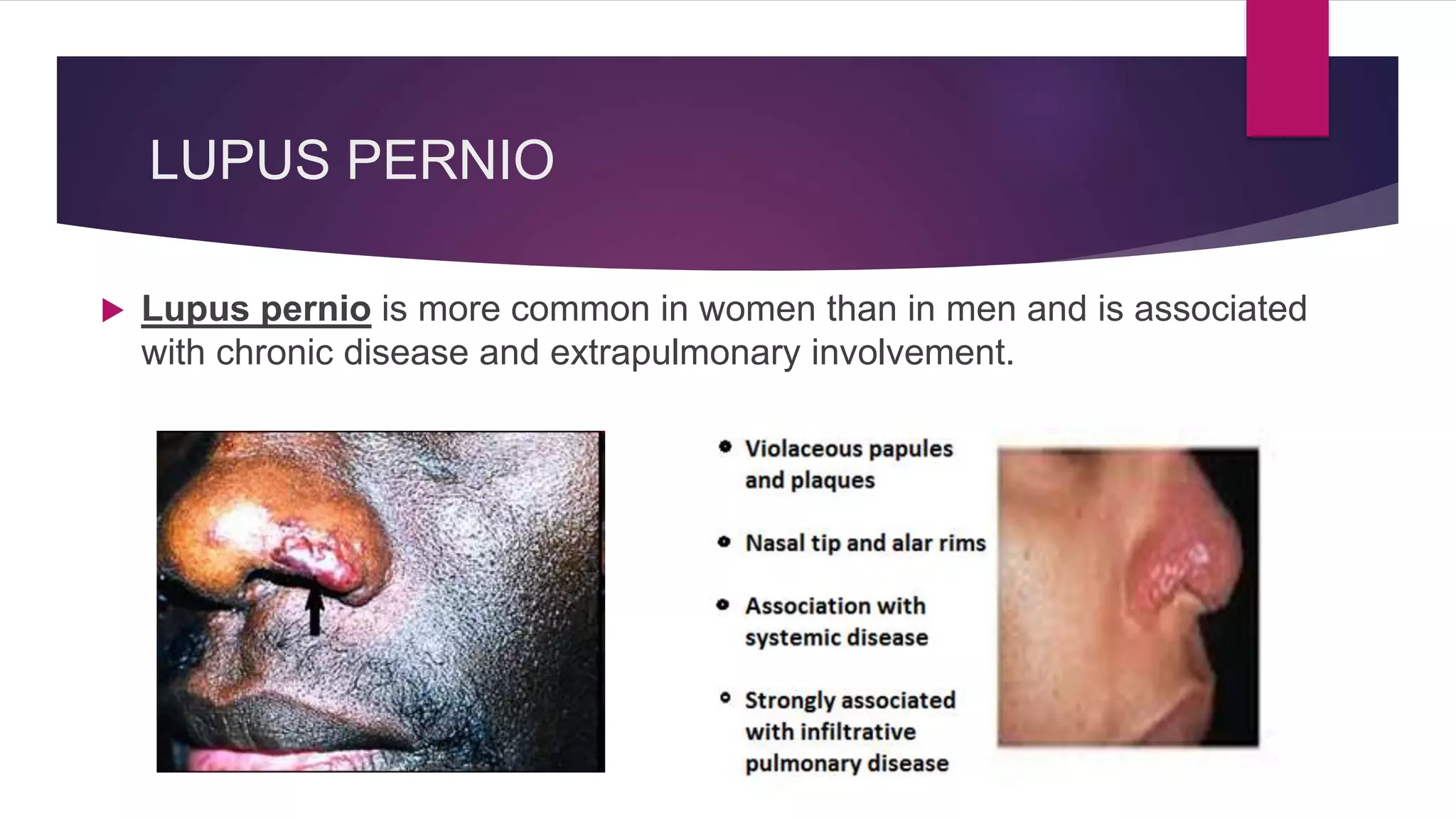 sarcoidosis-ppt