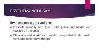 ERYTHEMA NODUSAM
Erythema nodosum syndrome
 Presents abruptly with fever, joint pains and tender red
nodules on the shins
 Often associated with hot, swollen, exquisited tender ankle
joints and other polyarthragia
 