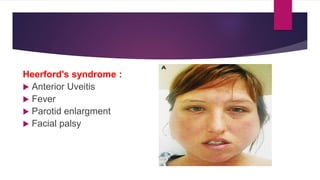 Heerford's syndrome :
 Anterior Uveitis
 Fever
 Parotid enlargment
 Facial palsy
 