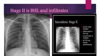 Stage II is BHL and infiltrates
 