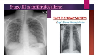 Stage III is infiltrates alone
 