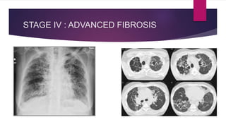 STAGE IV : ADVANCED FIBROSIS
 
