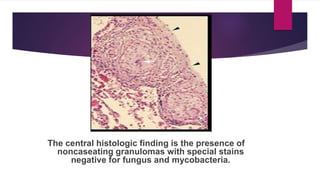 The central histologic finding is the presence of
noncaseating granulomas with special stains
negative for fungus and mycobacteria.
 