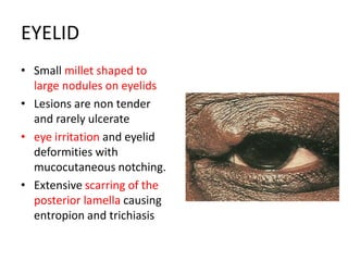 EYELID
• Small millet shaped to
large nodules on eyelids
• Lesions are non tender
and rarely ulcerate
• eye irritation and eyelid
deformities with
mucocutaneous notching.
• Extensive scarring of the
posterior lamella causing
entropion and trichiasis
 