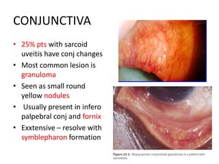 CONJUNCTIVA
• 25% pts with sarcoid
uveitis have conj changes
• Most common lesion is
granuloma
• Seen as small round
yellow nodules
• Usually present in infero
palpebral conj and fornix
• Exxtensive – resolve with
symblepharon formation
 